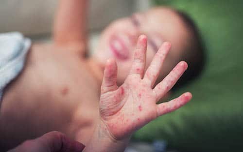 Hand Fuß Mund Krankheit: Symptome, Ansteckung, Dauer, Behandlung und Kita-Regeln hand fuß mund krankheit